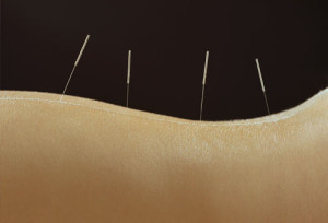 getty_rf_photo_of_acupuncture_needles_in_woman